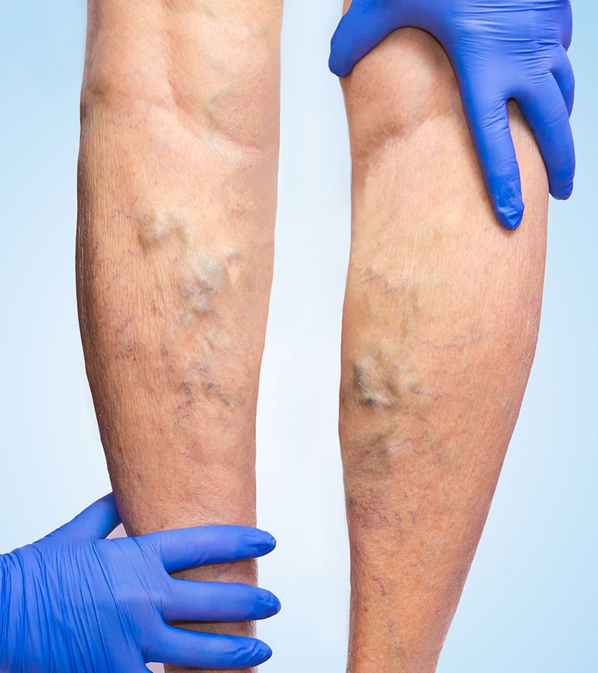 Service-varicose-vein-treatment